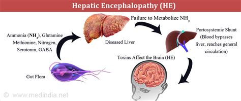 Hepatic Encephalopathy .